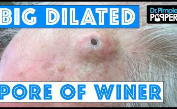 The Biggest Dilated Pore of Winer?!