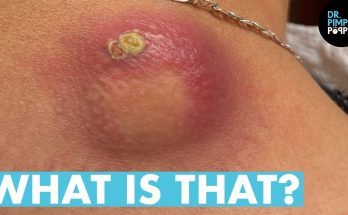 What is Skin cyst? Treatment & removal