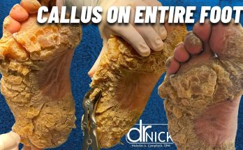 SHAVING CALLUS ON ENTIRE SOLE OF FOOT!!! Dr. Nick Campitelli, Foot & Ankle Surgeon