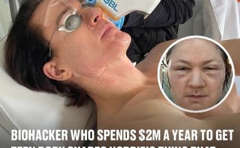 Biohacker who spends $2m a year to get teen body shares horrific thing that happened when he injected fat into face