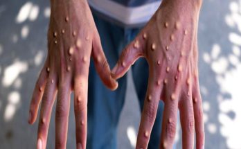 First case of new Mpox strain recorded in US, California health officials say