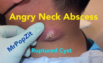 Angry Neck Abscess. Incision & Drainage. Packing removed 24 hours later. Great improvement!