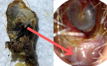 Huge Ear Wax Plug Extracted from Ear Crater due to Benign Osteonecrosis using WAXscope®️