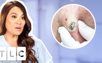 Top 7 Pimple Popping Moments: From A 55-Year-Old Blackhead To Oozing Fistulas!