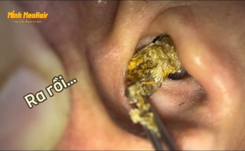 Earwax Removal Home Remedies