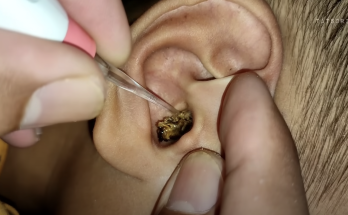 BIGGEST EARWAX REMOVAL | Huge Ear Wax Finally Removed After 10 Years