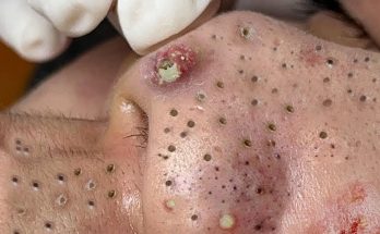 How Do You Remove Blackheads?