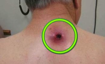 Cease and De-Cyst! 14 Minutes of Cyst Removal with Dr. Gilmore