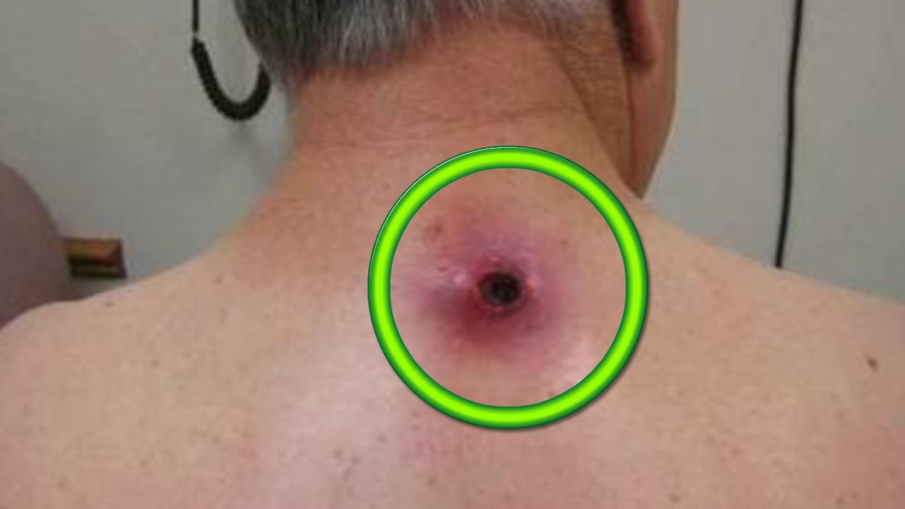 Cease and De-Cyst! 14 Minutes of Cyst Removal with Dr. Gilmore