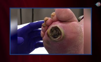 WCW: Debriding a Plantar Ulcer to Prevent Infection