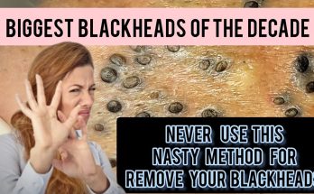 The disgusting removal of a 35-year-old blackhead