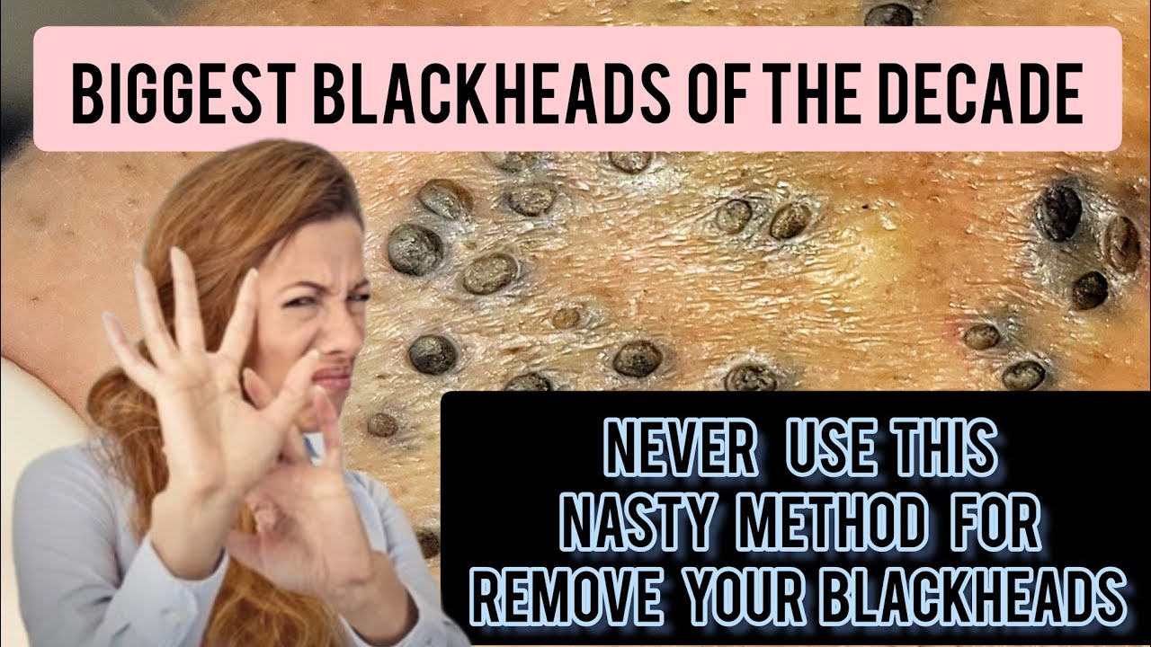 The disgusting removal of a 35-year-old blackhead