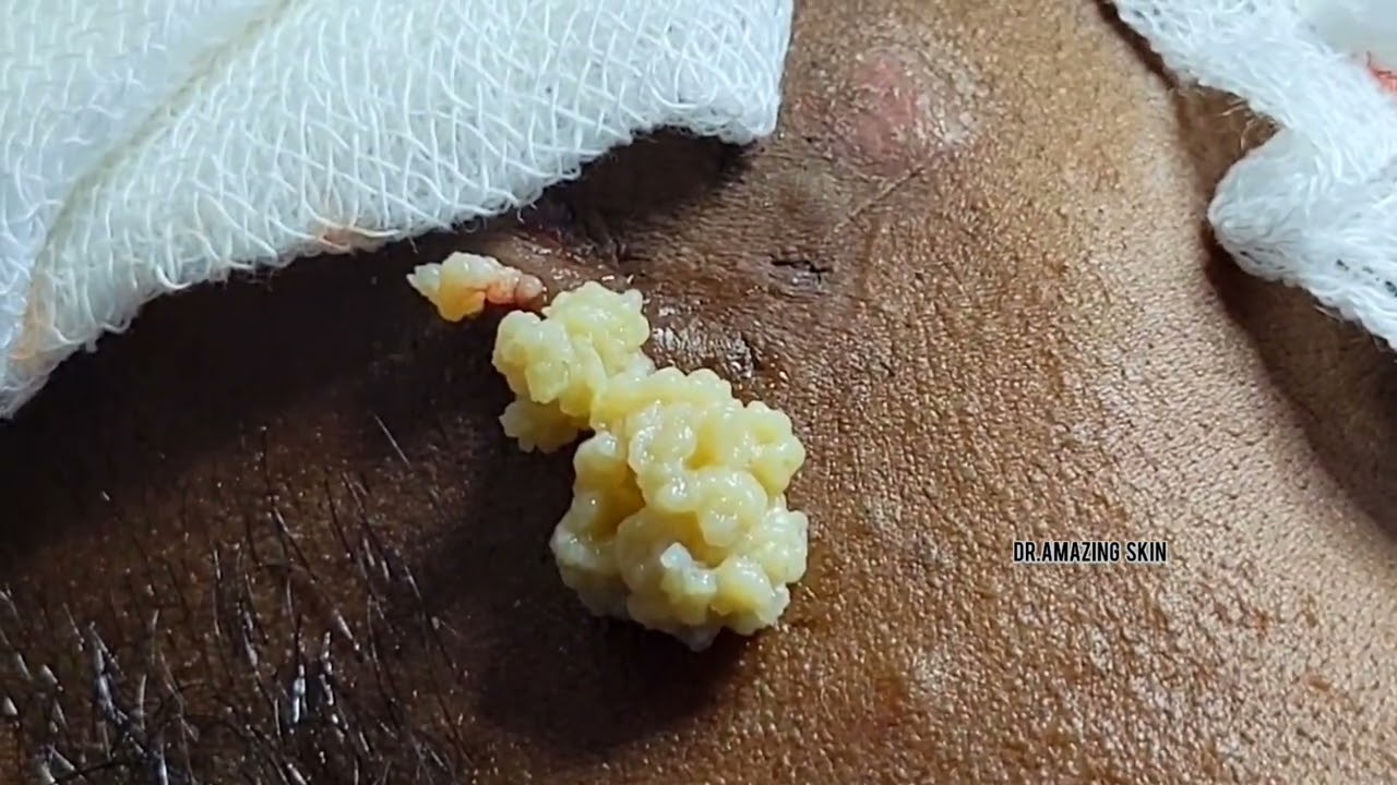 1...2....3.....Here we are popping a giant cyst| Dr.Amazingskin