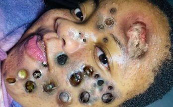 What are blackheads?