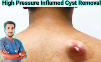 Infected Sebaceous Cyst Removal: Causes, Symptoms and Treatment Explained