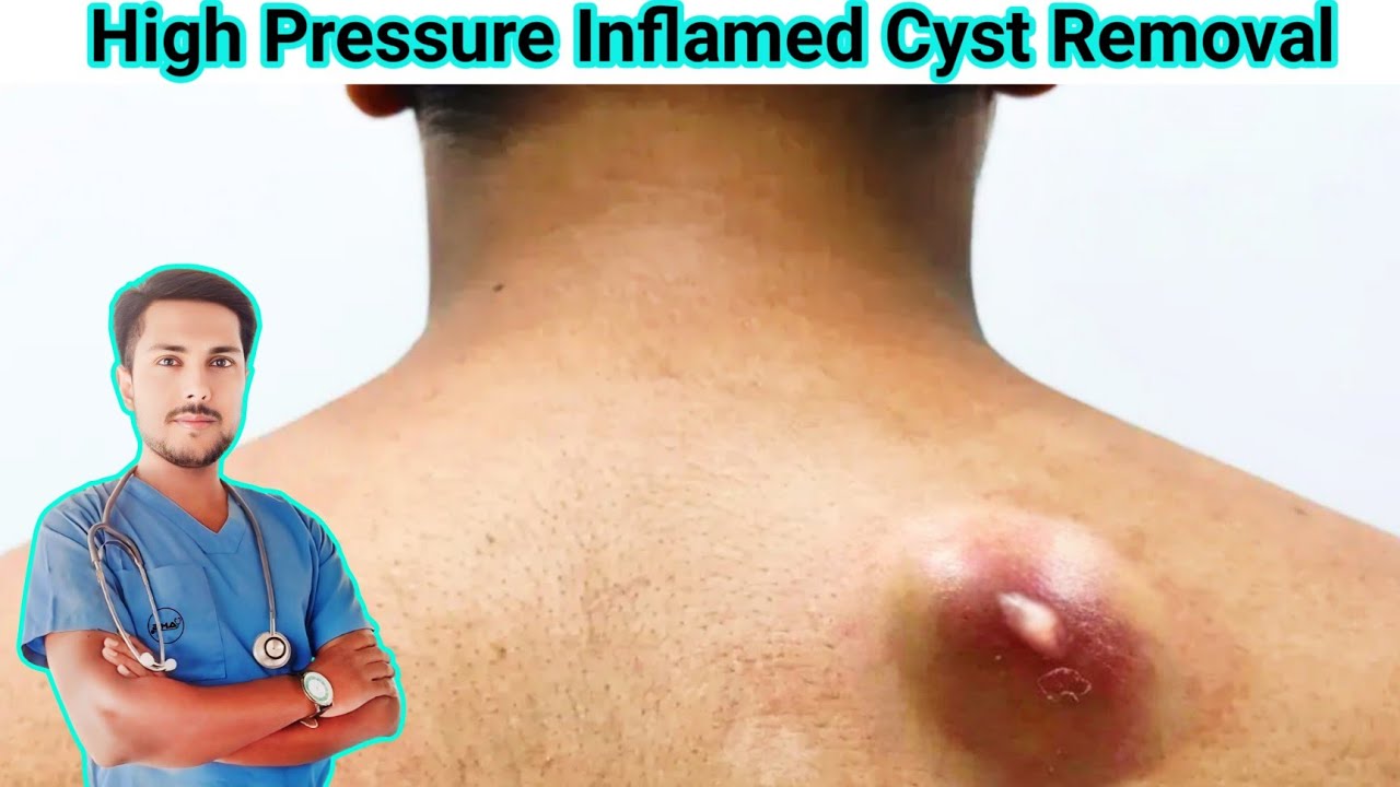 Infected Sebaceous Cyst Removal: Causes, Symptoms and Treatment Explained