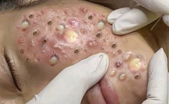 (VIDEO) Fast facts on blackhead removal