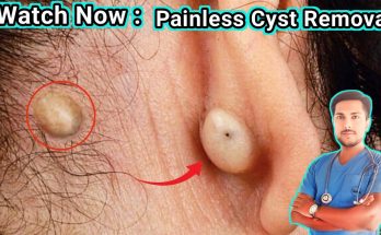 Educational Guide to Safe Cyst Removal Procedures Behind the Earlobe:Causes, Symptoms and Treatment