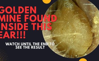 A GOLDEN Mine Found Inside This Ear!!! (Very Satisfying Earwax Removal Video)