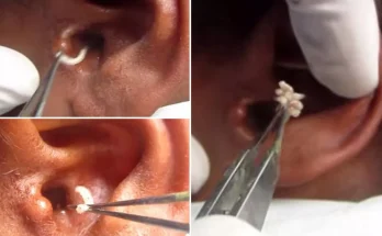 Successfully removed the maggots and repaired the ear By Dr.K.R.MEGHANADH