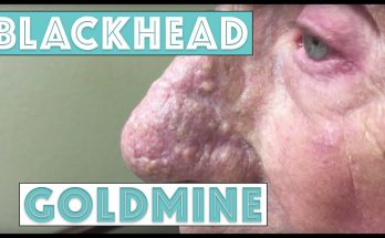 Watch Dr. Pimple Popper Pop a 'Goldmine' of Blackheads and Whiteheads