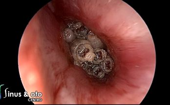 Myiasis of the ear (VIDEO)