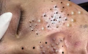 blackheads