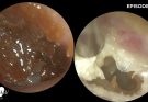 Possible Malignant Otitis Externa in Diabetic Patient