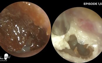 Possible Malignant Otitis Externa in Diabetic Patient