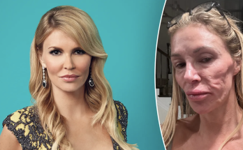 Brandi Glanville shares stripped down photo as she claims her 'looks are ruined' by mystery illness