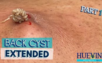 Part 1/3- Massive Back Cyst, Extended