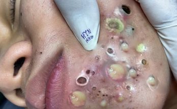 How do blackheads form?