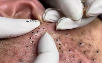 Full Blackhead Popping Video