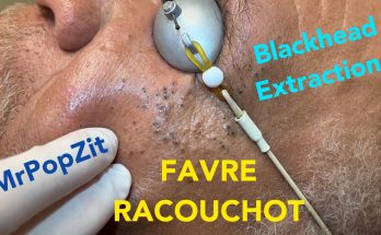 Favre Racouchot syndrome.Dozens of comedones extracted.Whiteheads and blackheads. Clearing the pores