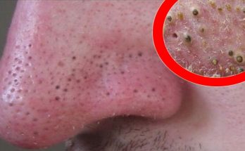 Blackheads, Whiteheads Extractions on "K"