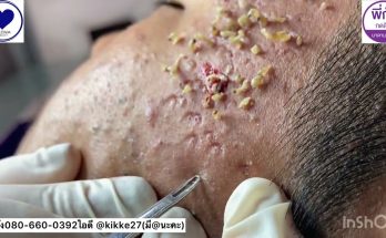 P'Kung has 810 acne pimples, open pimples, black stumps, long roots, buried deep for 2 years