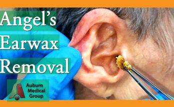 Monster Ear Wax Removal Brings New Life to JOKESTER Patient! | Auburn Medical Group