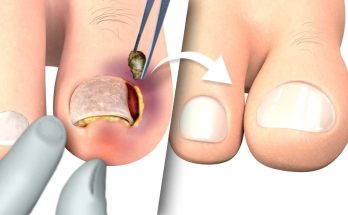 How To Treat an Ingrown Toenail