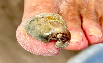 Super THICK CRUMBLY Toenail TRIMMING