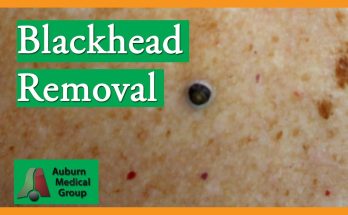 Blackhead Removal without Extractor Tool (Edited) | Auburn Medical Group