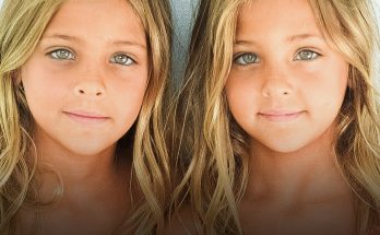 Identical Sisters Born in 2010 Grew Up to Become ‘Most Beautiful Twins in the World’ — How the Girls Look Now