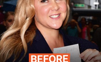 'I Feel Pretty' Star Amy Schumer Decided to Dissolve Her Facial Fillers – Before & After Photos