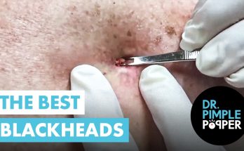 The Best Blackheads