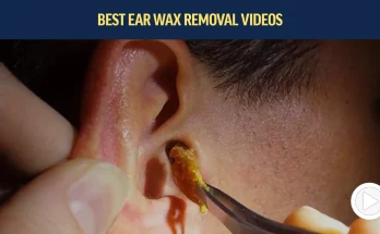 Perforating polyp in the ear canal.|ear wax removal | ear cleaning | ASMR | relaxation | relax