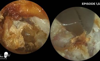 Ear Wax Removal, Dead Skin & Debris Extraction from Mastoidectomy Ear