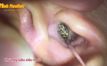 Do you believe his earwax is nearly 2 months old? - asmr-Earwax