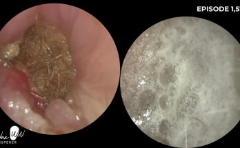 My Toughest Ear Wax Removal of 2024!