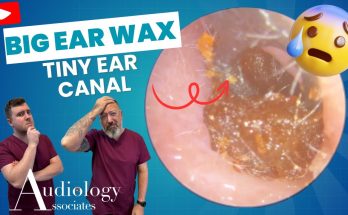 Epic Ear Wax Extraction: David vs. Goliath (Tiny Canal Edition!)