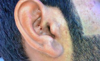 blackheads elderly in ear👂