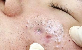 Blackhead Removal